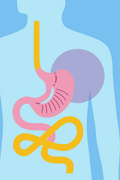 intestinal bipartition sleeve descriptive image